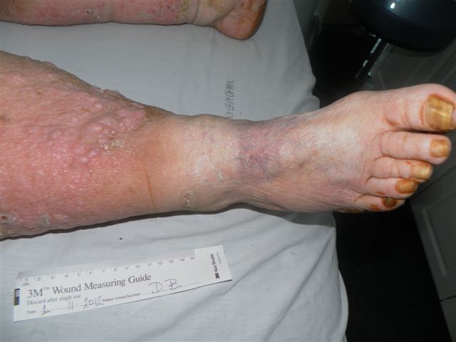 Venous Insufficiency  Healing the Generations