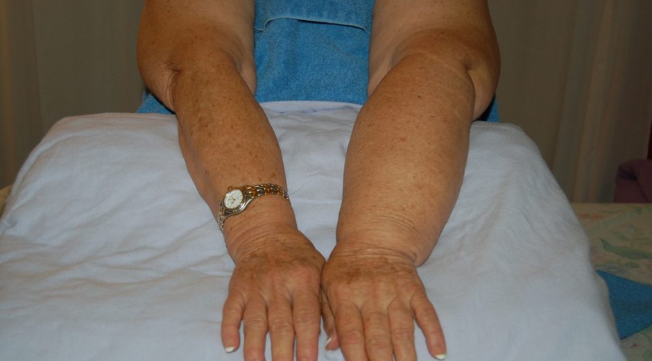 Lymphedema Treatment Center | Healing the Generations