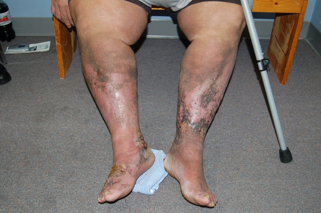 Venous Insufficiency